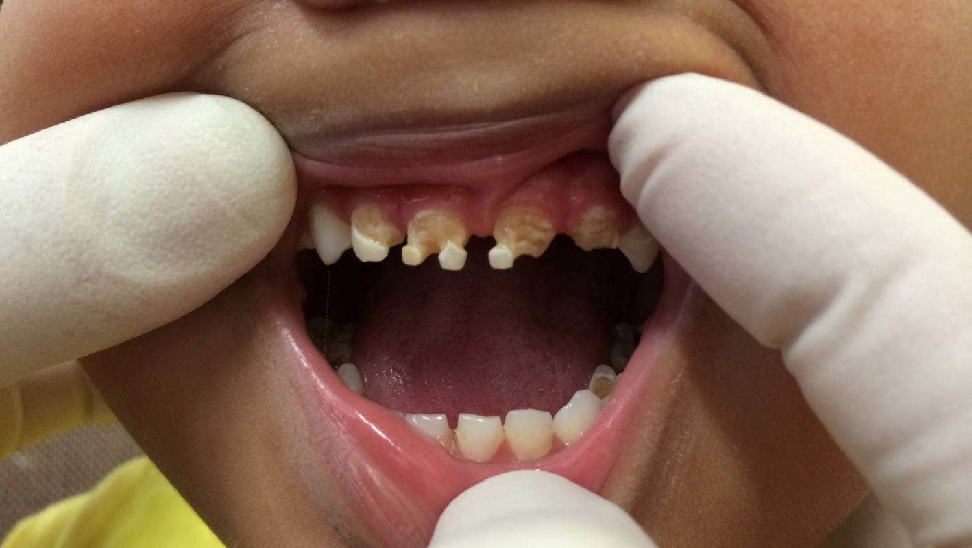 NZDA continues to be concerned about the dental health of Pasifika people in New Zealand