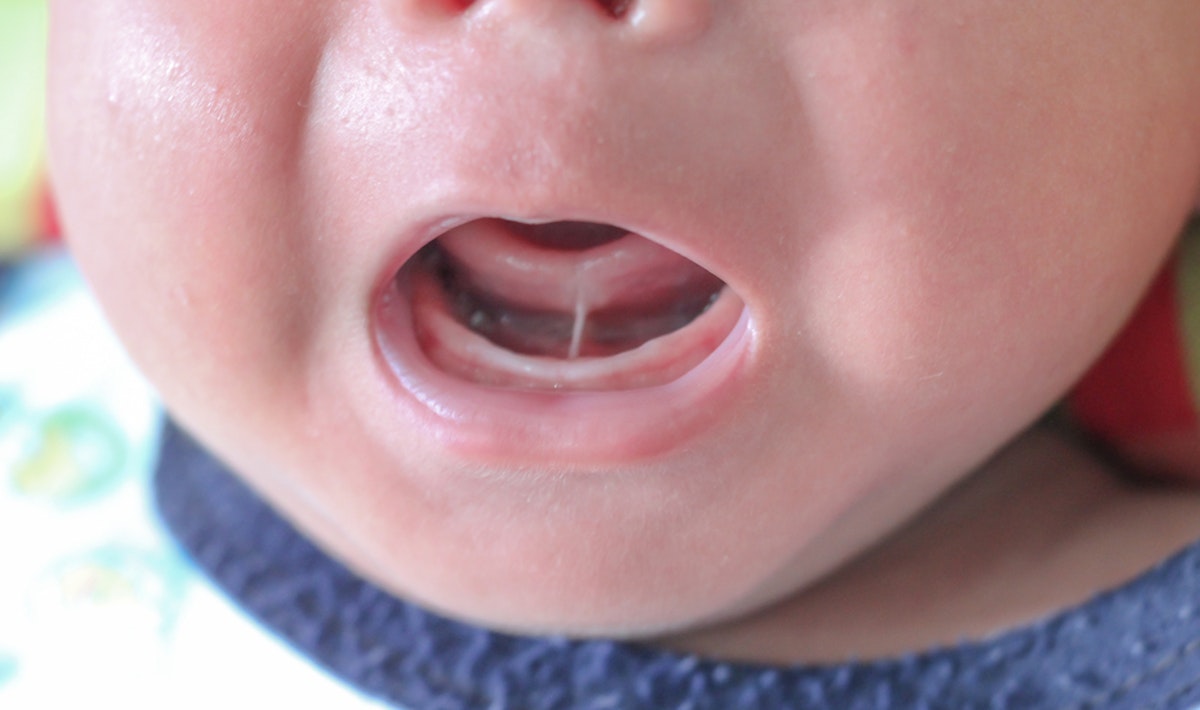 Tongue-tie surgery rise 'concerning' - dentists