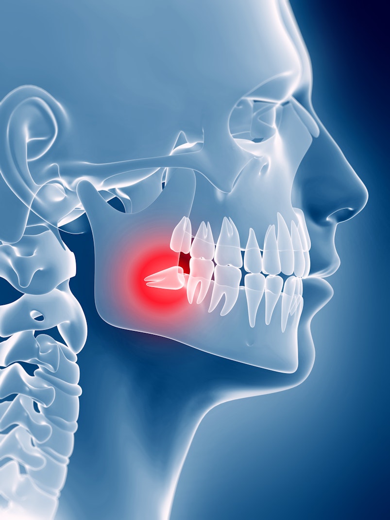 Impacted wisdom teeth